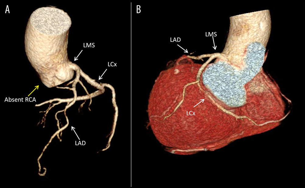 Computed tomography coronary angiogram. (A) Absence of take-off of the RCA from the right coronary sinus of Valsalva (yellow arrow) and normal origin of the LMS which bifurcates into the LAD and LCx (white arrows). (B) Course of the LCx on the posterior atrioventricular groove and continuation of its course in the RCA territory along with take-off of the posterior descending artery. LAD – left anterior descending artery; LCx – left circumflex artery; LMS – left main stem artery; RCA – right coronary artery.