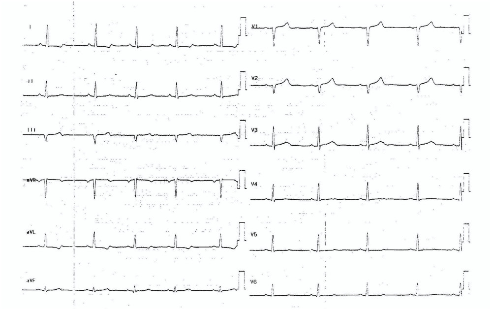 Resting electrocardiogram on admission. Sinus rhythm with T wave abnormality in the inferior and lateral leads (I, II, III, and aVL) without ST depression.