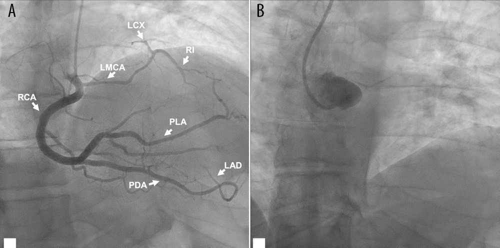 (A) Coronary angiography revealed the anomalous origin of the left main coronary artery (LMCA) arising from the right coronary artery (RCA). The LMCA originated from the left circumflex (LCX) and the ramus intermedius (RI). The RCA originated from the posterior descending artery (PDA) and the posterolateral artery (PLA). (B) Nonselective angiography in the left sinus of Valsalva showed the absence of the LMCA.