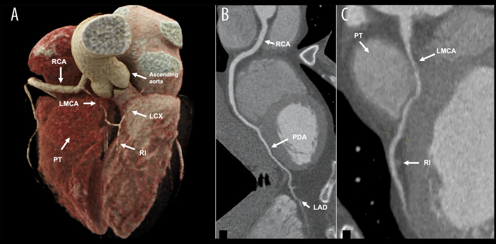 (A) Volume-rendered image from the coronary computed tomography angiography (CCTA) showed the abnormal origin of the left main coronary artery (LMCA) from the right coronary artery (RCA). It also showed the interarterial course of the LMCA between the ascending aorta and the pulmonary trunk (PT), originating from the left circumflex (LCX) and the ramus intermedius (RI). (B) Multiplanar reformation oblique reconstructions showed the anomalous origin of the left anterior descending artery (LAD) from the posterior descending artery (PDA). (C) Multiplanar reformation oblique reconstructions showed the malignant trajectory of the LMCA between the ascending aorta and the pulmonary trunk, associated with an intramyocardial pathway, originating from the RI.