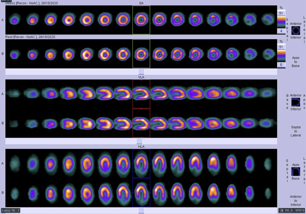 Nuclear stress 99mTc-sestamibi scintigraphy showed no residual inducible ischemia under stress at the follow-up.