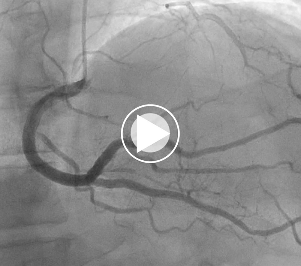 Coronary angiography revealed an anomalous origin of the left main coronary artery (LMCA), arising from the right coronary artery (RCA) and originating from the left circumflex (LCX) and the ramus intermedius (RI).