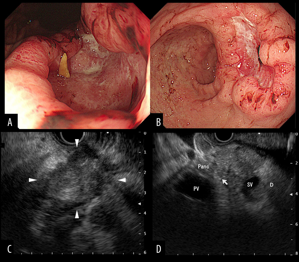 EGD and EUS findings. EGD before chemotherapy showing Borrmann type 3 cancers at the minor curvature of the gastric corpus (A) and the posterior wall of the gastric antrum (B). EUS showing a tumor mass with regional lymph nodes 27 mm in diameter (white arrowheads) between the posterior wall of the antrum and the head and body of the pancreas (C). The tumor in the gastric antrum is seen invading (white arrow) the head and body of the pancreas (D). EGD – esophagogastroduodenoscopy; EUS – endoscopic ultrasonography; Panc – pancreatic body; PV – portal vein; SV – splenic vein.