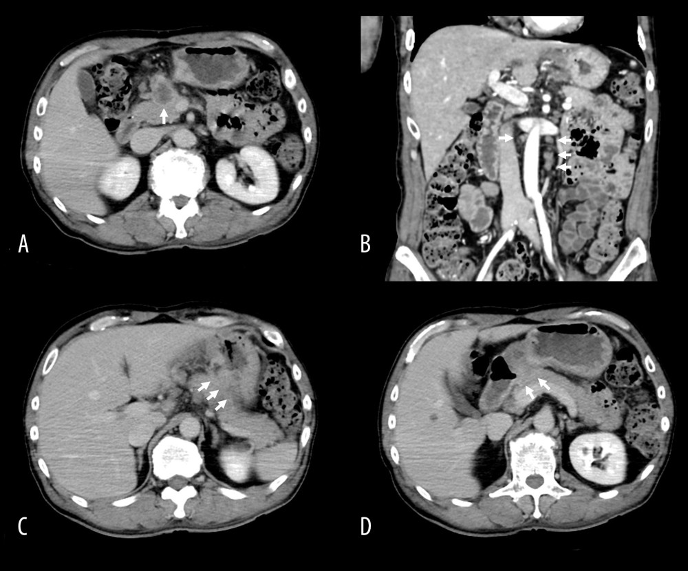 Enhanced CT images before chemotherapy. Abdominal CT before chemotherapy showing swollen regional lymph nodes (white arrow) and para-aortic lymph nodes (white arrow) on enhanced imaging (A, B). CT scans demonstrating the tumor in the middle of the gastric corpus invading (white arrows) the tail of the pancreas (C), and that the tumor in the gastric antrum invading (white arrows) the head and body of the pancreas (D). CT, computed tomography.
