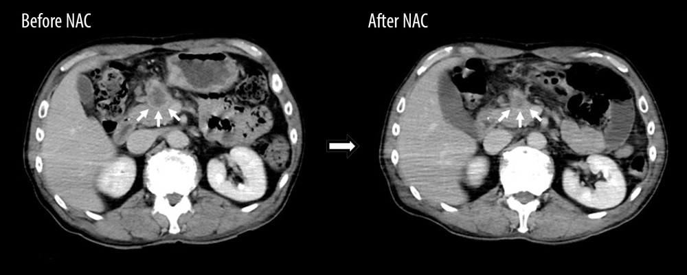 Change in lymph node size before and after NAC on CT images. After NAC, the mass consisting of tumor and regional lymph nodes between the posterior wall of the gastric antrum and the head and body of the pancreas is smaller than it was prior to chemotherapy (white arrows). CT – computed tomography; NAC – neoadjuvant chemotherapy.