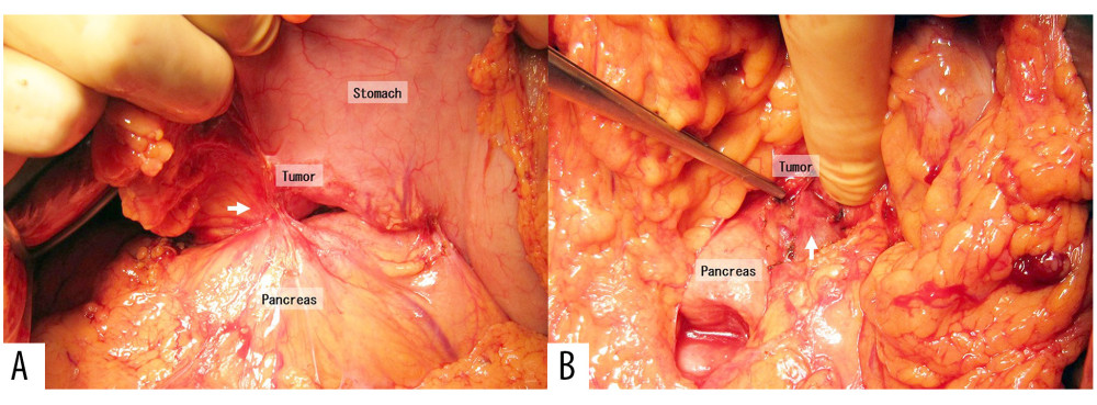 Intraoperative findings. The tumor in the gastric antrum invaded (white arrow) the capsule of pancreatic head (A). When the pancreatic capsule was peeled off, invasion of gastric cancer into the pancreatic parenchyma (white arrow) was observed (B).