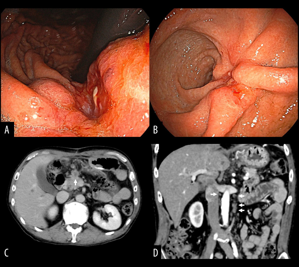 Follow-up EGD findings and CT images. EGD reveals reduction in size of the tumor at the minor curvature of the gastric corpus (A) and the posterior wall of the gastric antrum (B). CT scan shows reduction in size of the tumor mass and regional lymph nodes (white arrows) between the posterior wall of the gastric antrum and the head and body of the pancreas (C). The size of para-aortic lymph node metastases (white arrows) is reduced (D). CT – computed tomography; EGD– esophagogastroduodenoscopy.