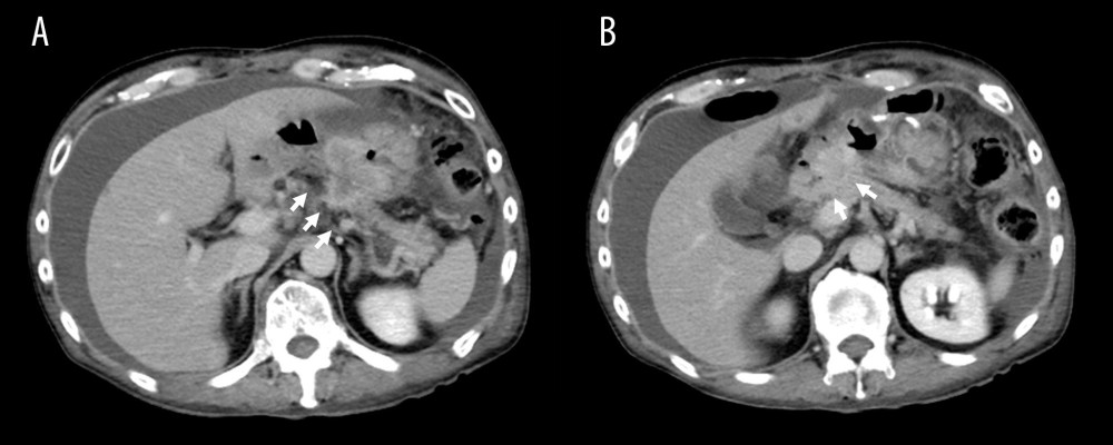 CT images 8 months after the start of treatment. CT scan showing increased primary tumors in the middle of the gastric corpus invading (white arrows) the tail of the pancreas (A), and the tumor in the gastric antrum invading (white arrows) the head and body of the pancreas (B). CT – computed tomography.