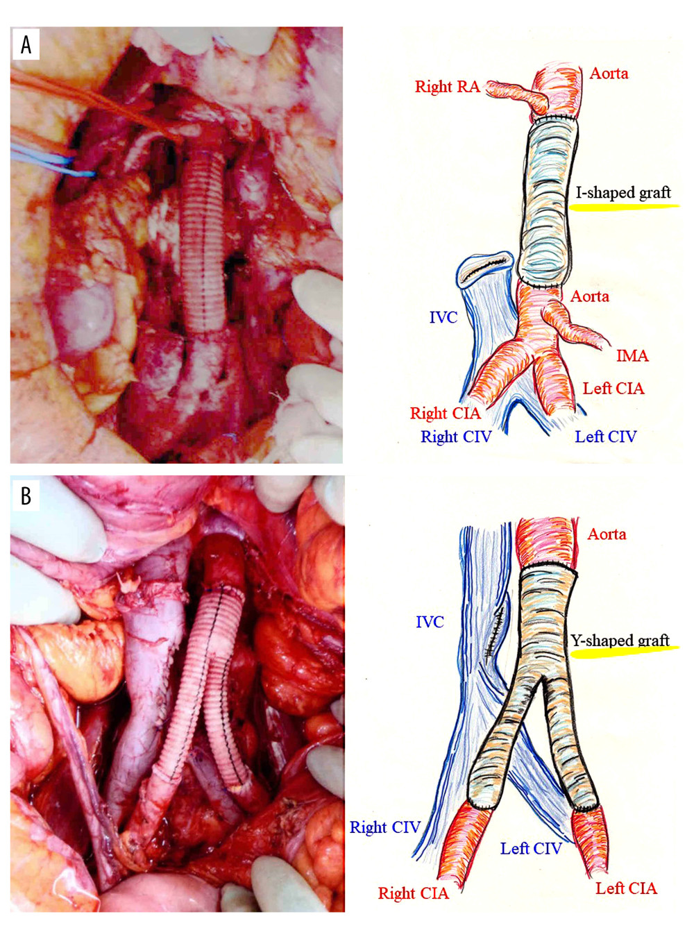 Arterial reconstruction using synthetic arterial graft. (A) An I-shaped graft was used to replace the abdominal aorta from the lower level of the renal artery to the upper level of the inferior mesenteric artery (Case 1). (B) A Y-shaped graft was used to replace the aorta from the root of the inferior mesenteric artery to the common iliac arteries 1 cm distal to the bifurcation bilaterally (Case 2). CIA – common iliac artery; CIV – common iliac vein; IMA – inferior mesenteric artery; IVC – inferior vena cava; SAG – synthetic arterial graft; RA – renal artery.