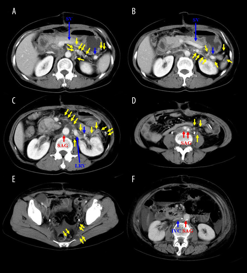 Venous flows of the IVC and left renal vein in early postoperative period after en bloc resection. (A-E) The IVC and LRV were resected for en bloc resection of PPT and actual findings of dynamic computed tomography at 13 days after surgery. Venous flow into the IVC was kept via developed collaterals in the pelvic space, gluteus maximus muscle, mesorectum and mesocolon, retroperitoneal space around the iliopsoas muscle and Gerota fascia (yellow arrows). These developed collaterals from the IVC flowed into the inferior and superior mesenteric veins and SV (yellow arrows). Venous flow of the LRV was kept mainly via splenorenal shunt (blue arrows), and other developed collaterals from the left renal vein flowed into the superior mesenteric vein and IVC (yellow arrows). Congestion or flow disorder was not observed in the left kidney. Hence, venous flow from the IVC and LRV were well preserved by developed collaterals and splenorenal shunt in the early postoperative period (Case 1). (F) The IVC was partially resected for en bloc resection of PPT, and actual findings of dynamic computed tomography at 14 days after surgery are shown. The patency of partially resected IVC was well kept from early postoperative period (Case 2). IVC – inferior vena cava; LRV – left renal vein; PPT – paraaortic and/or pelvic tumor; SAG – synthetic arterial graft; SV – splenic vein.