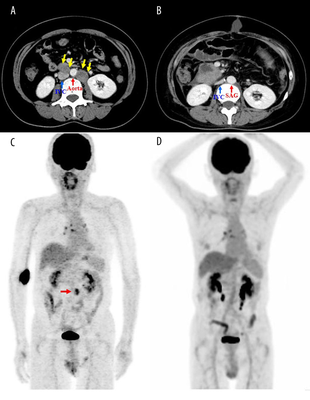 Graphical and surgical curability as institutional indication of aggressive resection of PPT. (A, B) Actual findings of dynamic computed tomography before aggressive resection of PPTs (yellow arrows, A) and at 10 days after surgery (B) are shown. Graphical and surgical curability was obtained (Case 4). (C, D) Actual findings of 18F-fluorodeoxyglucose positron emission tomography before aggressive resection of PPT (red arrow, C) and at 1 year after surgery (B) are shown. Graphical and surgical curability was obtained (Case 7). IVC – inferior vena cava; PPT – paraaortic and/or pelvic tumor; SAG – synthetic arterial graft.