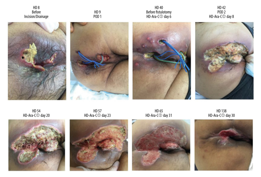Macroscopic appearance of the perianal abscess and the surgical wound. HD – hospital day; HD-Ara-C – high-dose cytarabine; POD – postoperative day.