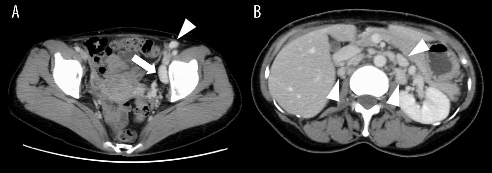 Abdominal contrast-enhanced computed tomography obtained at the first visit to our hospital in the tenth month of illness. (A) The lymph nodes in the left inguinal (arrowhead) and left external iliac regions (arrow) are enlarged. (B) Multiple lymph nodes are enhanced in the para-abdominal aortic region (white arrowheads).
