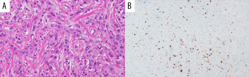 Pathological findings of the lymph node biopsy specimens of the left inguinal lymph node. (A) Hematoxylin and eosin (H&E) staining (×200) showing infiltration and proliferation of malignant cells with eosinophilic cytoplasm and round-shaped nuclei. (B) Gross cystic disease fluid protein (GCDFP)-15 staining (×100) showing that some of the malignant cells identified by H&E staining are positive with GCDFP-15 staining.