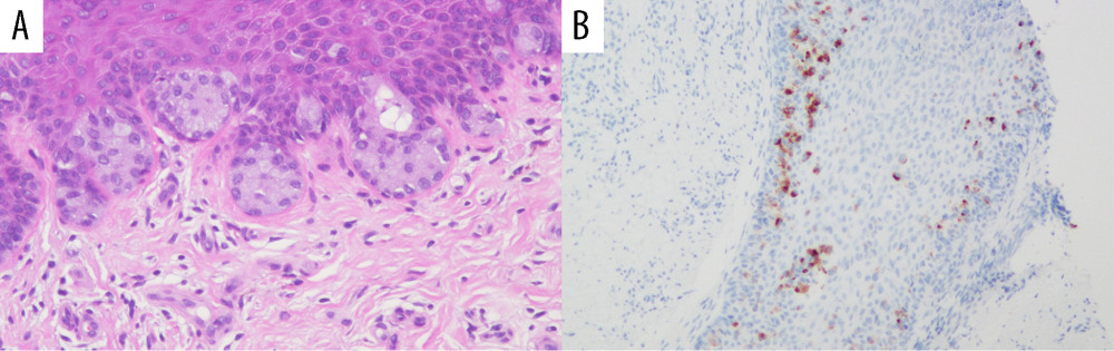 Pathological findings of the biopsy specimens of vulvar skin lesions. (A) Hematoxylin and eosin (H&E) staining (×400) showing Paget cells with bright cell bodies within the epidermis. (B) Gross cystic disease fluid protein-15 (GCDFP-15) staining (×200) showing that some of the malignant cells identified by H&E staining are positive with GCDFP-15 staining.