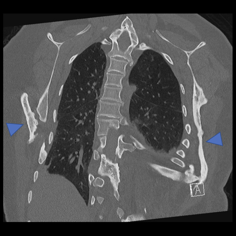 Computed tomography imaging demonstrating heterotopic bone formation (arrowheads) limiting thoracic expansion and creating restriction of ventilation.