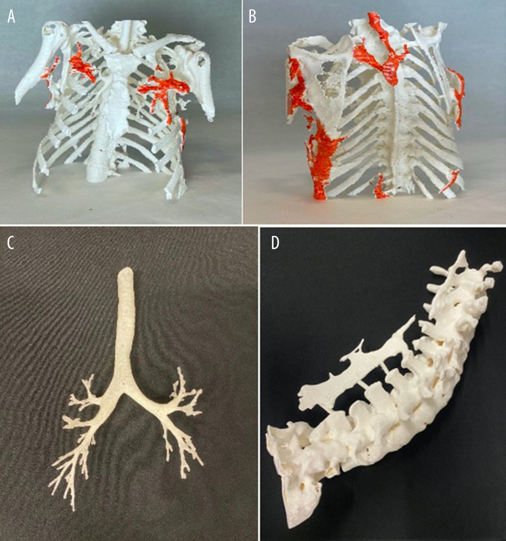 Three-dimensional models of the patient’s thorax: (A) anterior view; (B) posterior view, (C) tracheobronchial tree, and (D) T8-S1 spine. Orange color indicates the location of heterotopic bone.