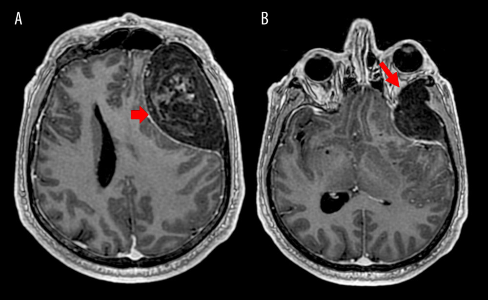 T1 sequences after contrast medium administration. (A) Extradural lesion of frontal region with midline shift and no contrast enhancement. (B) Upper orbital wall emaciation, compression of periorbita and exophthalmos. Red arrows show the tumor periphery.