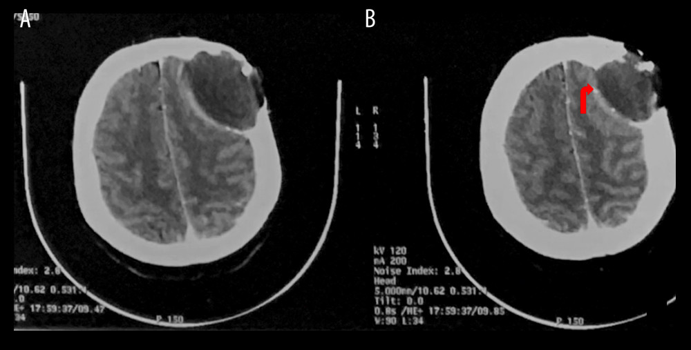 Preoperative CT scan showing eroding, primarily in the inner wall and partially the outer cortex of the calvarium. Red arrows show calcifications, which are also observable at the tumor’s rim.