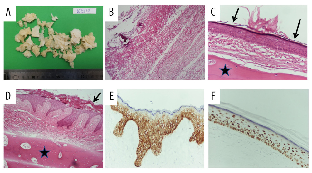 (A) Gross findings revealed soft white keratin contents. (B) Histological examination demonstrated abundant keratin flakes and (C, D) heavily keratinized squamous epithelium (bold arrows) adjacent to osseous tissue (star). The epithelial cells were positive for keratin 5/6 (E) and p63 (F). (B: HE ×100; C: HE ×400; D: HE ×100; E: IHC ×400; F: IHC ×400).