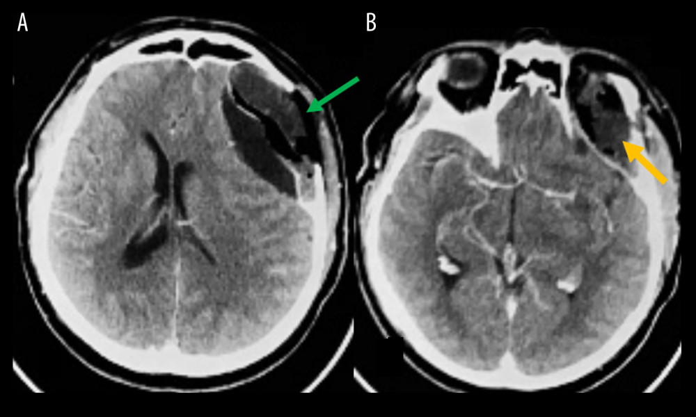 (A) Postoperative CT control. Green arrow shows the anatomic region of the resected tumor at the convexity. (B) Yellow arrow shows the tumor-free intraorbital space.