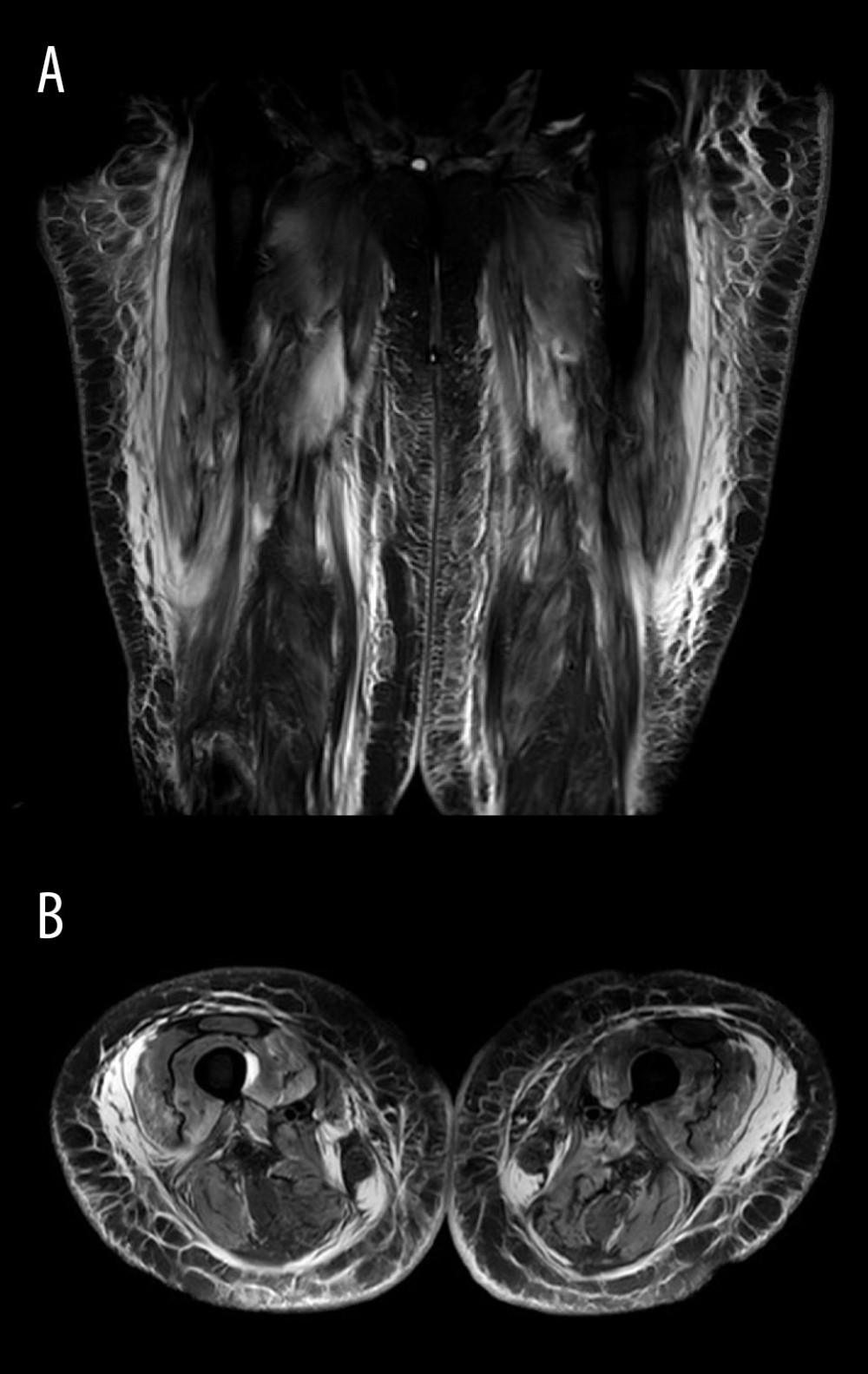 (A, B) MRI bilateral quadriceps showing diffusely increased T2 signal throughout the visualized musculature, with fluid present along the deep rectus femoris, consistent with diffuse bilateral thigh myositis and extensive subcutaneous edema without organized fluid collection.