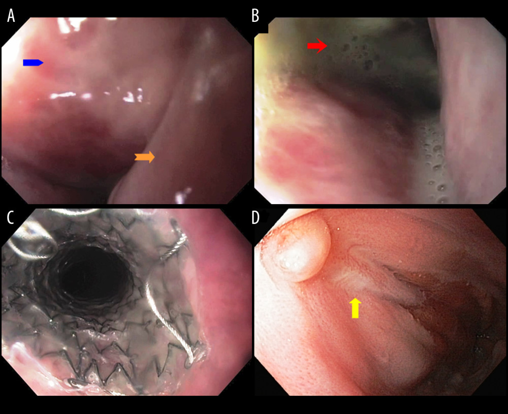 Endoscopic presentation of esophageal perforation in Boerhaave syndrome and its sealing with a self-expandable metallic stent. (A) Demonstrates a complete disruption of the esophageal wall and visible mediastinal tissue (orange sharp-ended arrow indicates the edge of esophageal wall without no detectable pre-existing pathology; blue smooth arrow indicates mediastinal tissue). (B) Demonstrates connection to the left pleural cavity with purulent discharge (red sharp arrow). (C) Demonstrates the EndoMAXX stent after implantation. (D) Demonstrates scar (yellow regular arrow) sealing of the site after esophageal perforation 8 weeks after stenting.