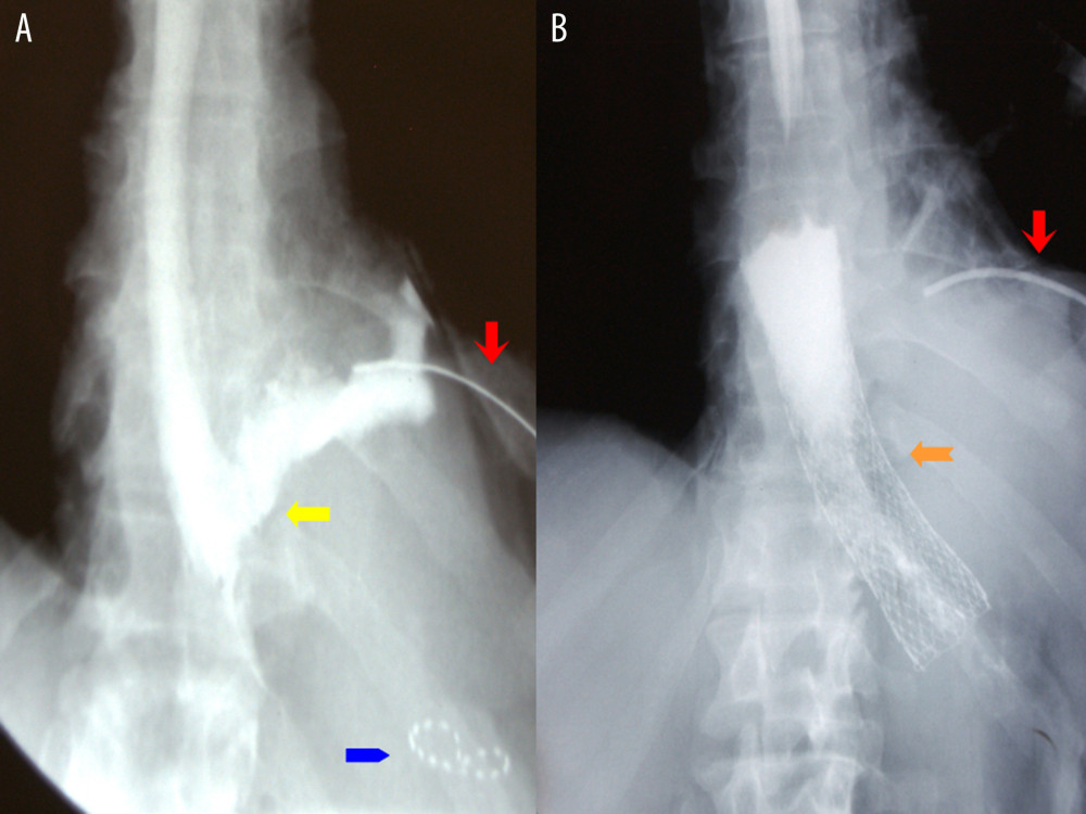 Radiological presentation of esophageal perforation in Boerhaave syndrome and its sealing with a self-expandable metallic stent. (A) Demonstrates an extravasation of water-soluble contrast through the esophageal perforation 2 days after endoscopic implantation of the Polyflex stent that migrated to the stomach (yellow regular arrow indicates the site of perforation; blue smooth arrow indicates migrated Polyflex stent; red sharp arrow indicates a chest tube). (B) Demonstrates a water-soluble contrast swallow 7 days after endoscopic implantation of the EndoMAXX stent (orange sharp-ended arrow indicates stent across esophago-gastric junction sealing esophageal perforation; red sharp arrow indicates a chest tube).