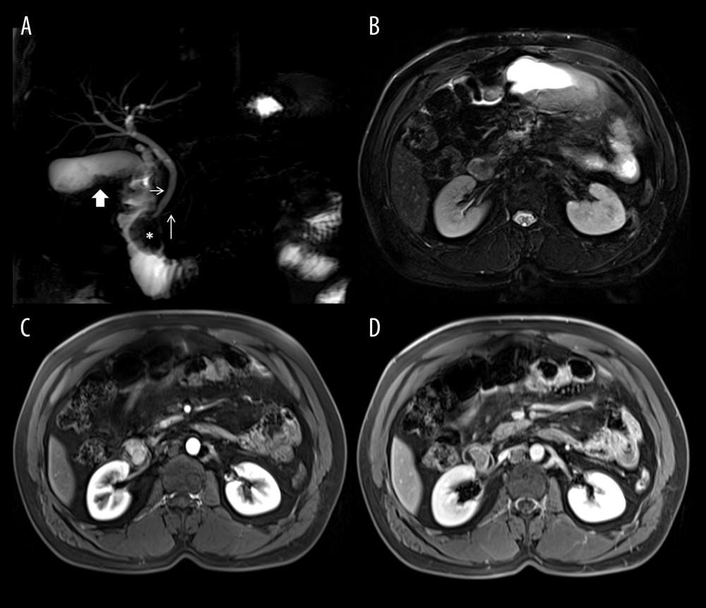Magnetic resonance cholangiopancreatography (A) and selected axial magnetic resonance images (B–D) demonstrating an ampullary-based mass located within the lumen of the second part of the duodenum (*). The common bile duct (arrow) and the pancreatic duct (long arrow) are normal. The mass had a moderate signal on T2-weighted image (B). Enhancement of the mass in the arterial phase (C) and washout in the venous phase (D) are seen.