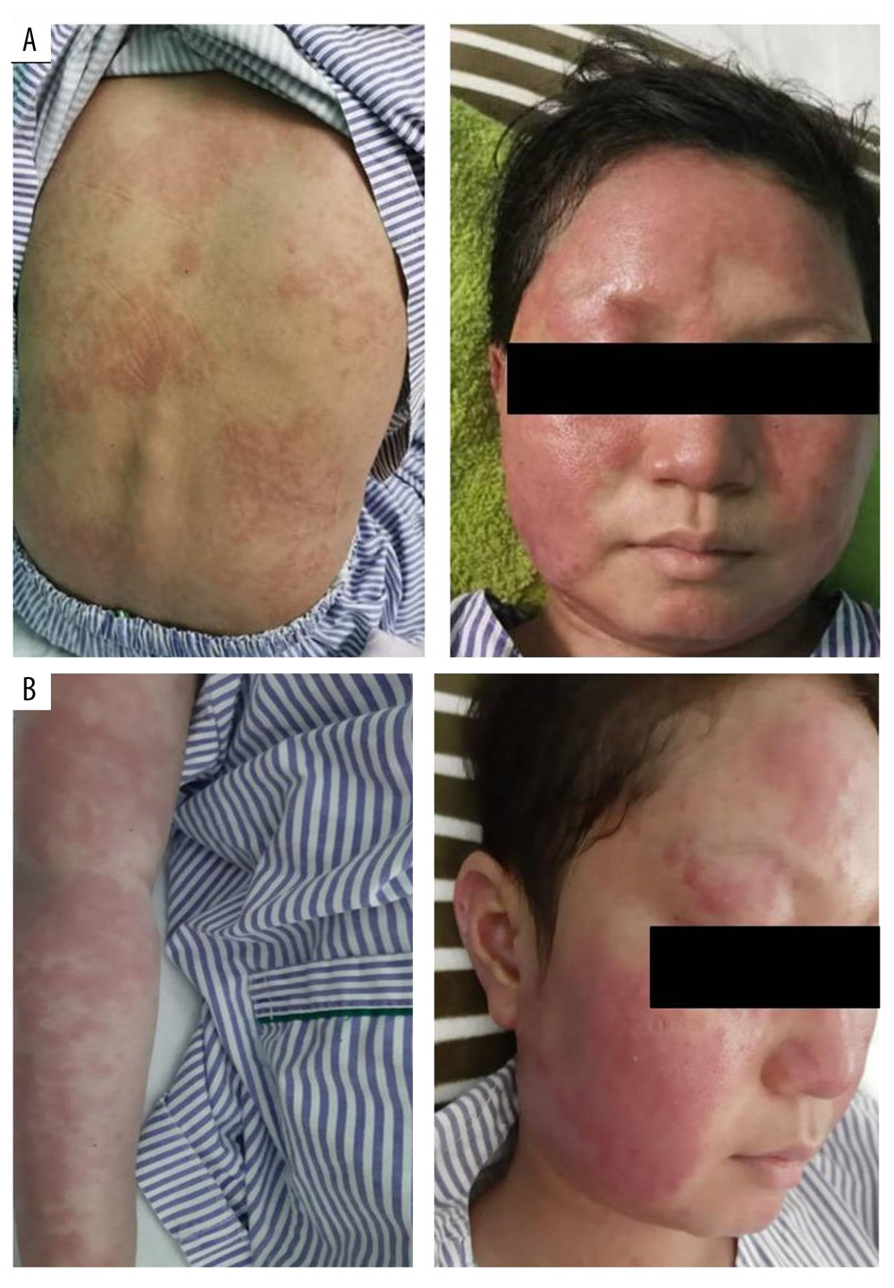 (A) Pruritic, erythrodermic-like skin rashes. (B) Type II erythema nodosum leprosum reaction.