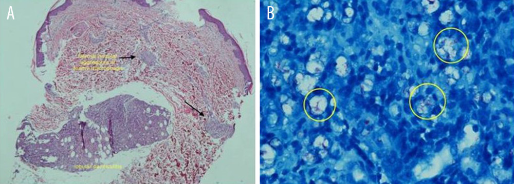 Skin biopsy: (A) dermal nodular aggregates of foamy macrophage with lobular panniculitis in part of the subcutaneous layer; (B) fite stain showed many intracellular acid-fast bacilli.