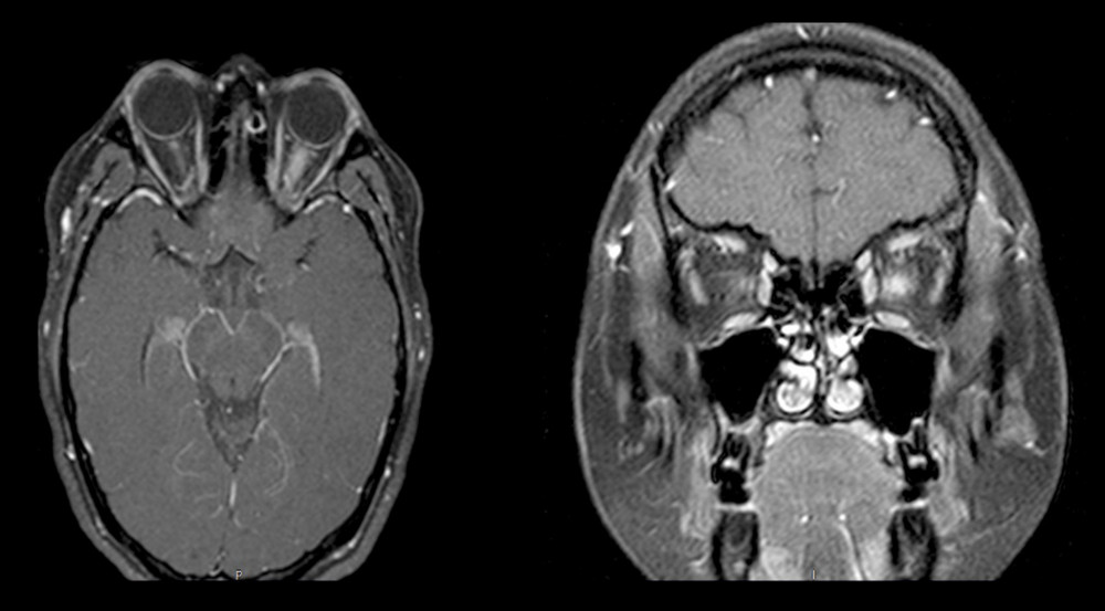 Axial and coronal views of brain on MRI, showing optic neuritis of the left optic nerve.