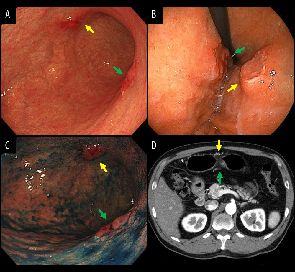 Multiple gastric carcinomas. (A–C) “Kissing” lesions were observed in the stomach. The 2 lesions (yellow and green arrows) were located in the anterior (yellow arrow) and posterior walls (green arrow) of the gastric body. They were pathologically diagnosed as moderately differentiated tubular adenocarcinoma. (D) Both lesions (yellow and green arrows) were detected with dynamic computed tomography. GC – gastric carcinoma.