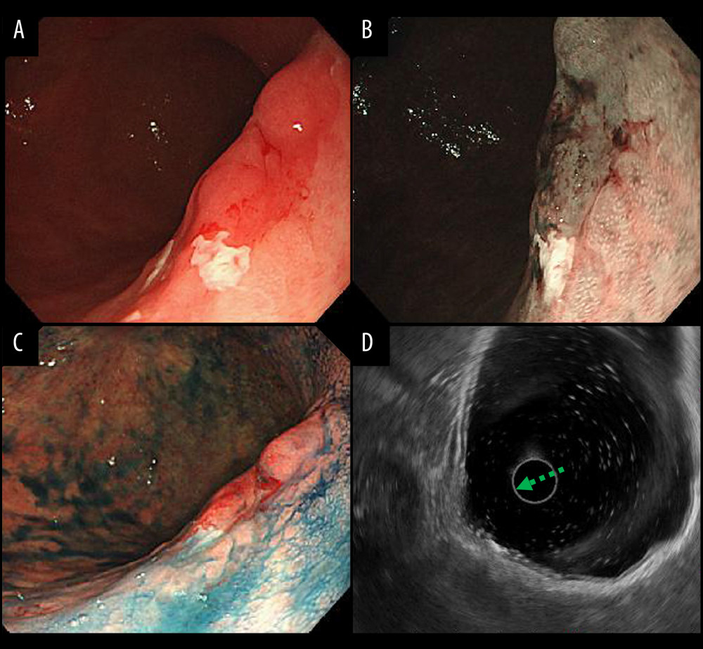 Gastric carcinoma (GC) in the posterior wall of the gastric body. (A–C) The GC in the posterior wall of the gastric body measured 25 mm. (D) Endoscopic ultrasound (dotted green arrow) suggested that the carcinoma might have invaded the muscularis propria. GC – gastric carcinoma.