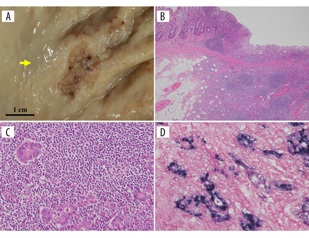 Macroscopic findings and microscopic assessments of the gastric carcinoma (GC) in the anterior wall of the gastric body. (A) Macroscopic findings from the GC in the anterior wall of the gastric body (yellow arrow). (B, C) Pathologic findings based on hematoxylin and eosin staining (B, ×80, C, ×200). Both moderately differentiated tubular adenocarcinomas had invaded the submucosal layer. Marked lymphocytic infiltration into the stroma was seen on in situ hybridization of Epstein-Barr virus (EBV). (D) Immunohistochemical examination with in situ hybridization of EBV was positive for EBV-encoded small ribonucleic acid. EBV – Epstein-Barr virus, GC – gastric carcinoma.
