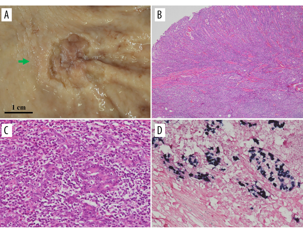 Macroscopic findings and microscopic assessments of gastric carcinoma (GC) in the posterior wall of the gastric body. (A) Macroscopic findings from the GC in the posterior wall of the gastric body (green arrow). (B, C) Pathologic findings based on hematoxylin and eosin staining (B, ×80, C, ×200). Both moderately differentiated tubular adenocarcinomas had invaded the submucosal layer. Marked lymphocytic infiltration into the stroma was seen on in situ hybridization of EBV. (D) Immunohistochemical examination with in situ hybridization of Epstein-Barr virus (EBV) was positive for EBV-encoded small ribonucleic acid. EBV – Epstein-Barr virus, GC – gastric carcinoma.