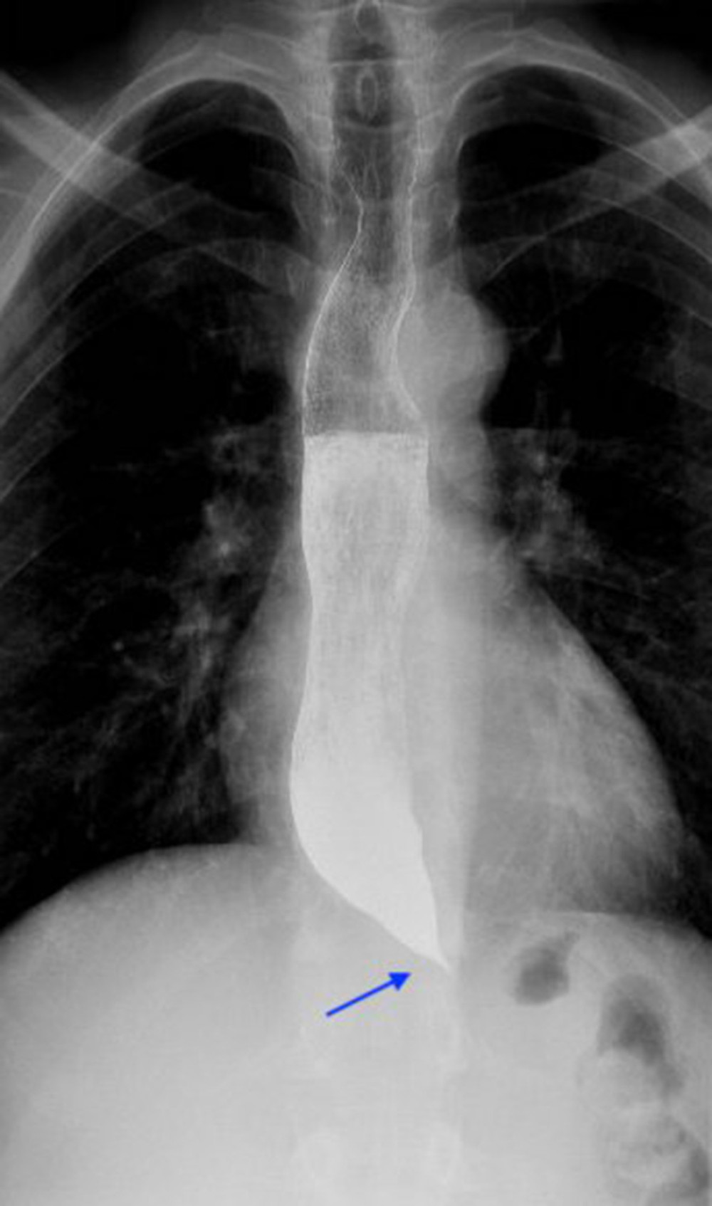 Pre-operation Gastrografin swallow study showed tapering of the contrast at the distal part of esophagus (bird’s beak appearance) suggestive of achalasia.