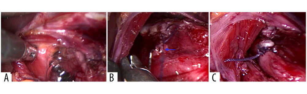 Intraoperative pictures: (A) leak test, which is showing bubbles from the perforation site, (B) small perforation of the esophagus, and (C) primary repair of the perforation.