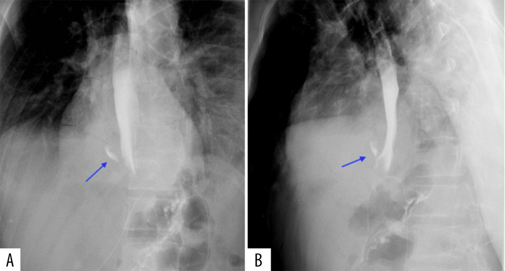 Postoperative (A) anteroposterior and (B) lateral views of Gastrografin swallow study showing leak on the right side before stenting.