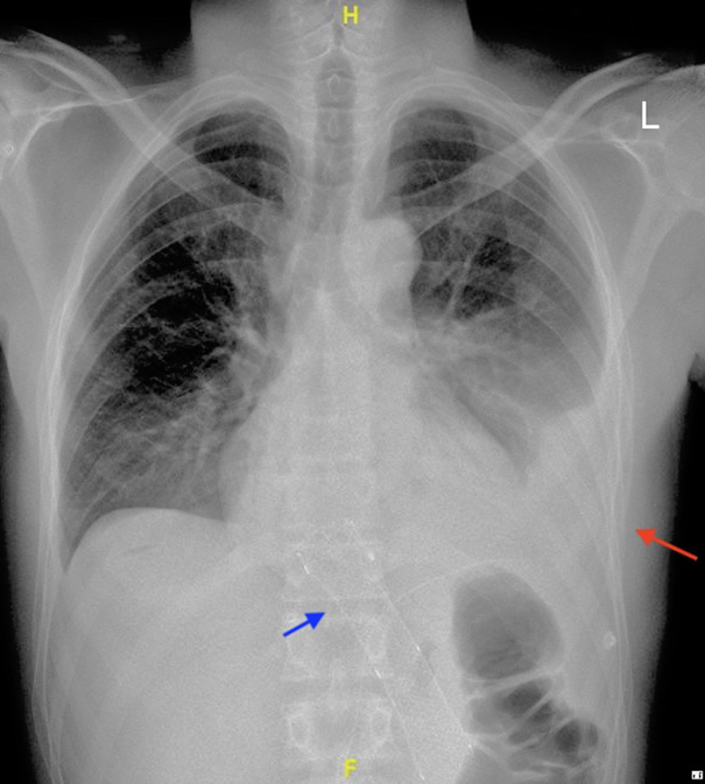 X-ray showing stent migration (blue arrow) with left-side pleural effusion (red arrow).
