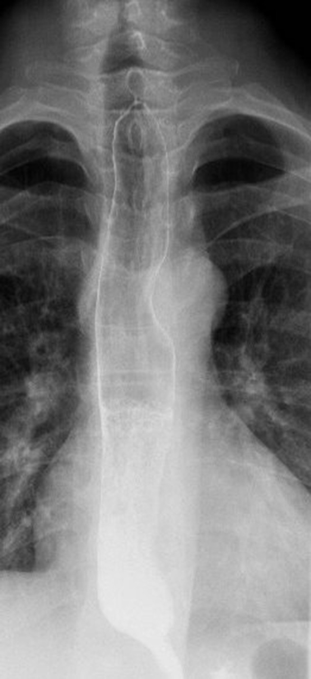 Gastrografin swallow after removal of the stent, showing no leak.