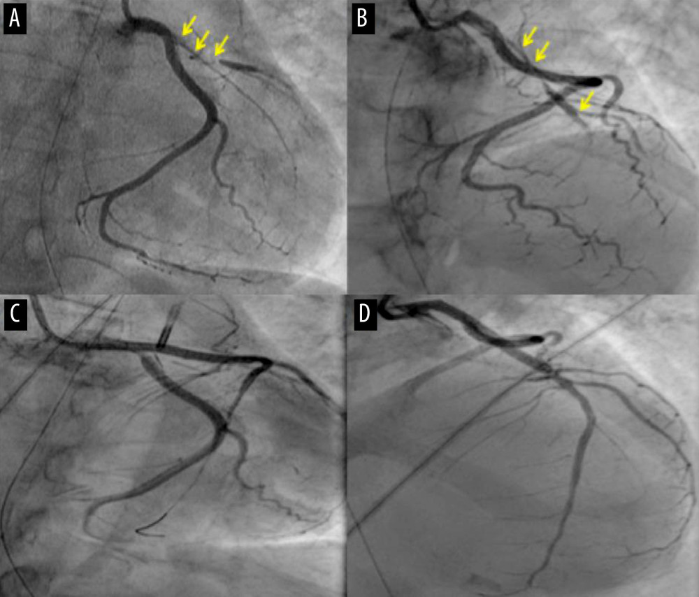 Coronary angiogram revealing an occlusion of the ostium of the proximal segment of the LAD staining contrast (yellow arrow) in right anterior oblique view (A) and right anterior cranial view (B). Successful PCI with stent implant from left main to proximal LAD in the respective views (C, D).