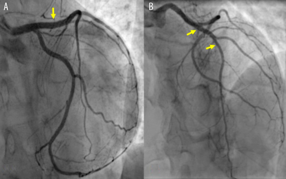 Planned coronary angiogram at 3 months, showing a good result of the stent implantation in the left main stem toward the LAD (yellow arrows) in the caudal (A) and cranial (B) views.