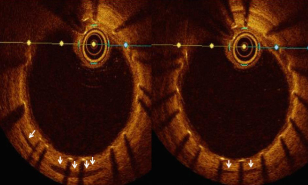 Planned optical coherence tomography (OCT) at 3 months, after postdilatation, highlighting residuals intramural hematoma in a form of a lunar crescent (white arrow) with good stent apposition in the LAD.