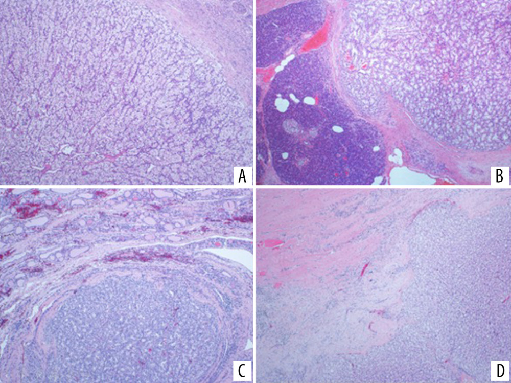 (A) Histological examination of the kidney tumor shows infiltration by malignant clear epithelial cells arranged in nests typical of clear cell renal cell carcinoma (ccRCC); Hematoxylin and eosin (H&E) 100×, (B–D) Sections of the pancreas, thyroid, and soft tissue masses, respectively, showing metastatic ccRCC with similar primary tumor features (H&E, 40×, 100×, 100×).