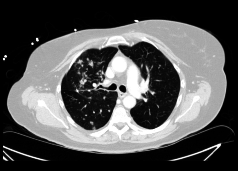 Progression of pulmonary nodules on computed tomography.