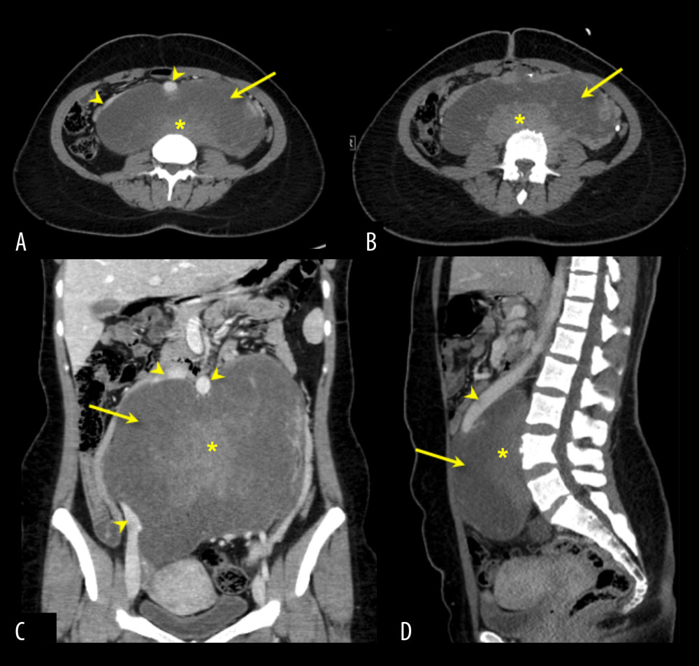 (A, B) Axial, (C) coronal, and (D) sagittal computed tomography scans with intravenous contrast reveal a large retroperitoneal soft tissue mass (arrow) anteriorly displacing the aorta and the inferior vena cava (arrowheads). The mass is predominantly hypodense with enhancing soft tissue components (asterisk).