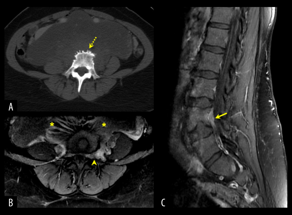 Relation of the mass to the spine. (A) An axial computed tomography scan of the bone shows erosions and remodeling of the L4 vertebral body (dotted arrow). (B) Axial and (C) Sagittal post-contrast T1-weighted magnetic resonance imaging shows a partially visible, heterogeneously enhancing retroperitoneal perivertebral mass (asterisks) surrounding the L4 vertebral body. It extends into the left L4-5 neural foramen (arrowhead) with an anterior epidural enhancing component opposite L4.