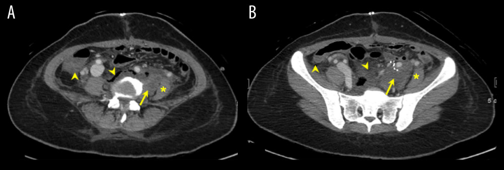 (A, B) Contrast-enhanced axial computed tomography scans of the retroperitoneal mass taken after resection. They show immediate postoperative changes in the form of pneumoperitoneum, pneumoretroperitoneum, and intraperitoneal and retroperitoneal free fluid (arrowheads). There is a hypoenhanced soft tissue residual close to the anterior and medial to the left psoas muscle (asterisk) and posterior to the common left iliac vessels (arrows).