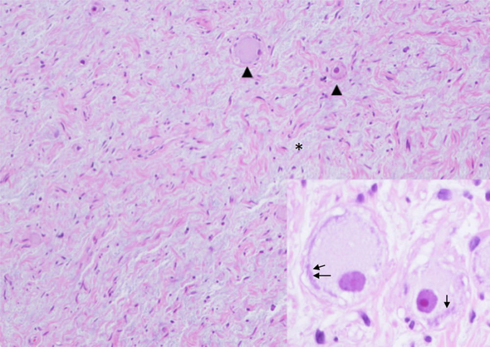At low magnification, the tumor is predominantly composed of Schwannian stroma with a loose, gray-to-blue, myxoid background (asterisk) and scattered ganglion cells (arrowheads). At higher magnification, the inset shows mature ganglion cells with the prominent nucleoli and basophilic granules at the periphery of the cytoplasm (Nissl substance, arrow).